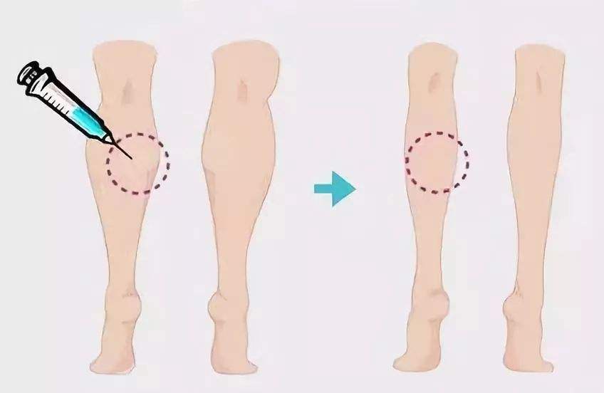 瘦腿针副作用